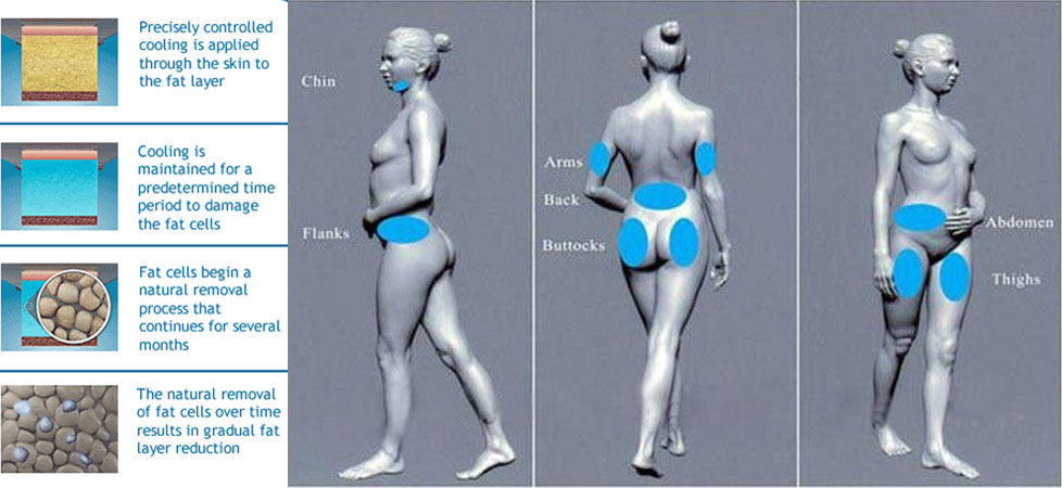Suitable areas for Cryolipo