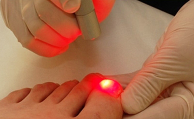 laser nails fungus